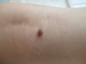 皮膚線維腫　黒く盛り上がったできもの