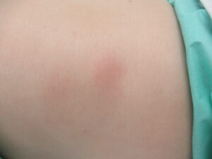 脂肪腫　なだらかにドーム状に隆起　柔らかく触れる　掲載同意あり