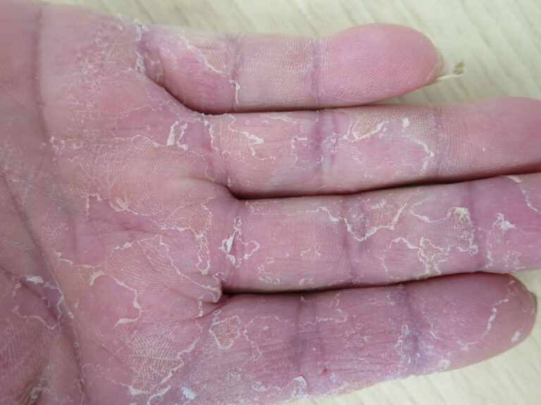 たむし(体部白癬)の治療・症状|北九州市八幡西区の皮膚科【ひびきの皮ふ科】