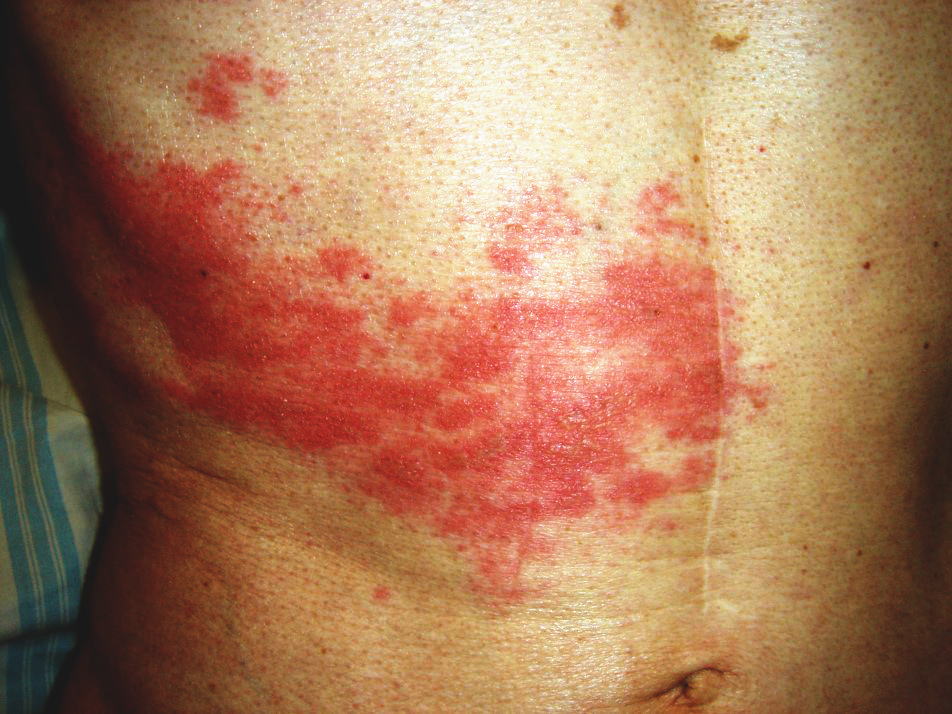 発疹を刺激しないようにする