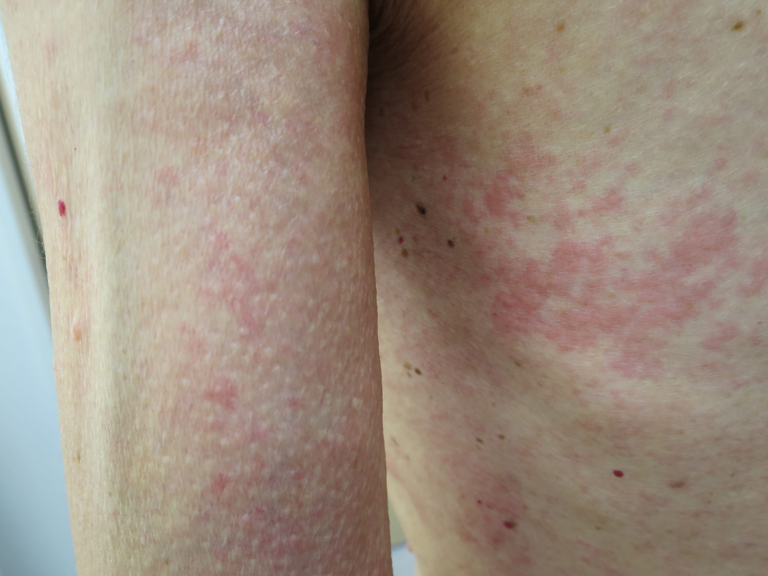 過度の発汗を治療する方法