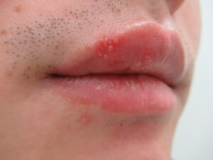 上の唇に1mm大の小水疱が多発しています。