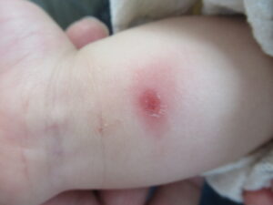 腕のとびひ　びらんになっています。
