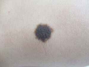 黒く少し盛り上がっているほくろ。毛も生えることがある。