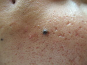 盛り上がった黒いホクロ