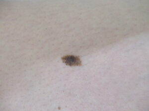 平たい茶色っぽく黒いホクロ