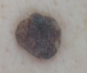 盛り上がったタイプのホクロ　黒い。