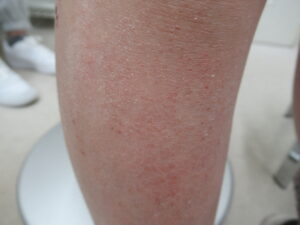子供の乾燥性湿疹 すねに赤み、粉のような乾燥があります。