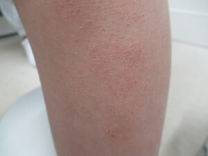 子供の乾燥性湿疹 左のすねに赤み、粉のような乾燥があります。