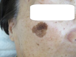 悪性黒色腫　転載禁止