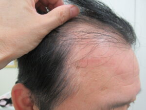 ひたいの角の髪がうすくなり後退しています。