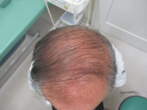頭部の髪がうすくなっています。