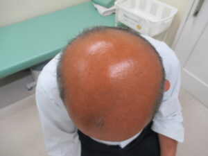 頭部の髪が広くうすくなっています。