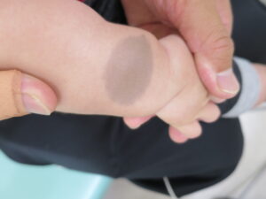 腕の異所性蒙古斑 青あざ