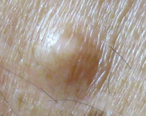 硬化性線維腫