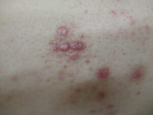 結節性痒疹　4mm台までの赤く隆起した硬いものが多発しています。