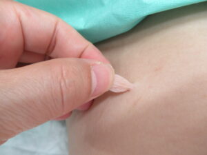軟性線維腫