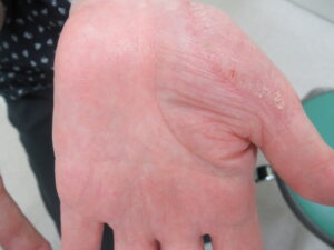 手に赤み、亀裂、皮むけがあります。