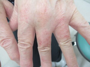 手に赤み、亀裂、皮むけ、乾燥があります。