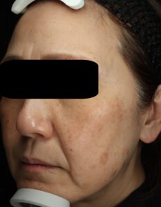 ピコトリートメント前