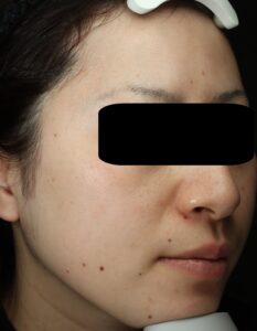 ピコトリートメント前