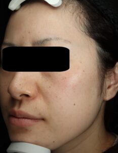 ピコトリートメント前