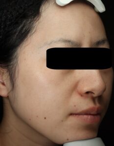 ピコトリートメント後