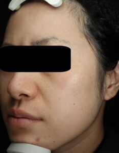 ピコトリートメント後