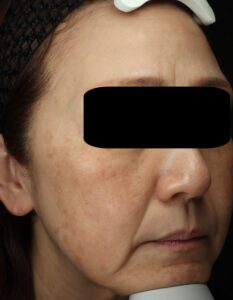 ピコトリートメント後