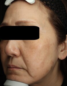 ピコトリートメント後