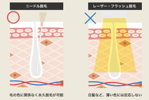 ニードル脱毛とは