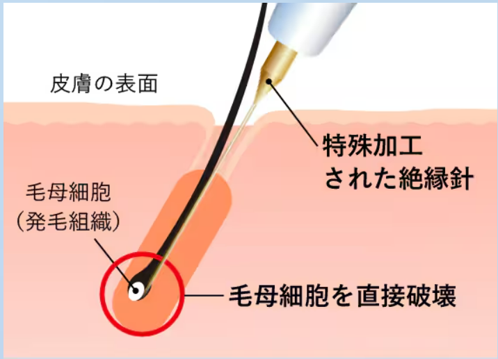 ニードル脱毛の原理と仕組み