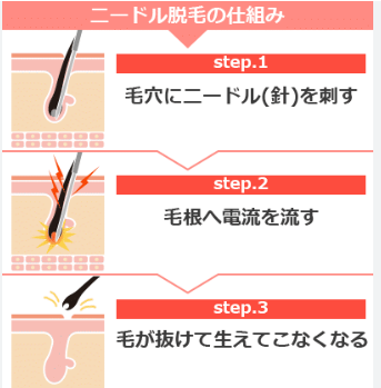 ニードル脱毛の原理と仕組み