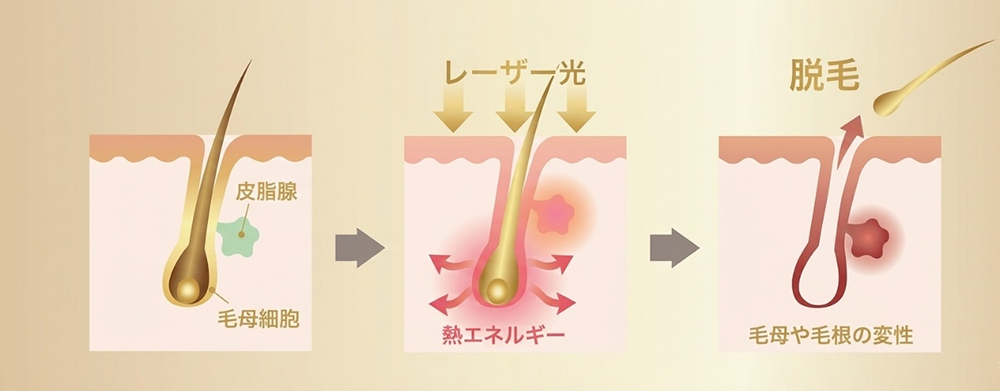 医療脱毛の基本的な仕組み