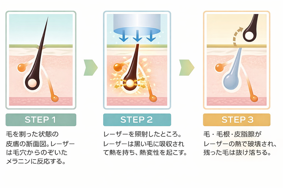 照射時に起きている4つのステップ