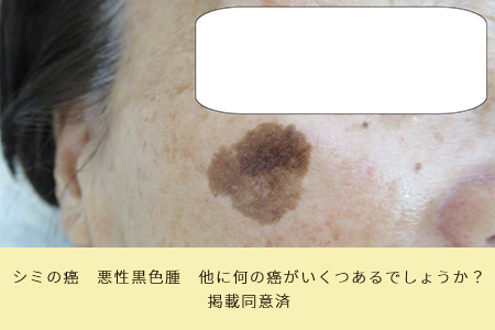 シミの癌 悪性黒色腫 他に何の癌がいくつあるでしょうか? 掲載同意済
