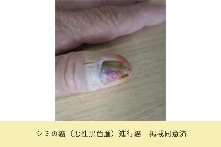 シミの癌(悪性黒色腫)進行癌 掲載同意済