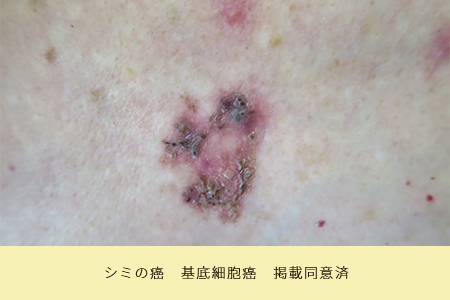 シミの癌 基底細胞癌 掲載同意済