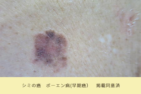 シミの癌 ボーエン病(早期癌) 掲載同意済