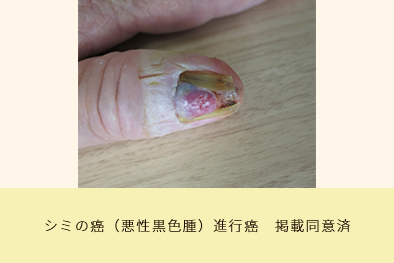 シミの癌（悪性黒色腫）進行癌　掲載同意済